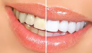 Tratamiento de Blanqueamiento dental en Dental Family Center