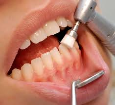 Tratamiento de Periodoncia en Dental Family Center